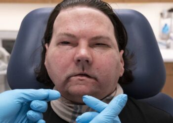 Un hombre de 22 años recibe el primer trasplante de cara y manos