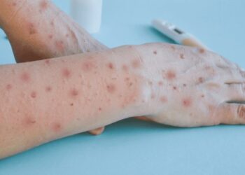 Ministerio de Salud Pùblica notifica dos nuevos casos de viruela símica en el país