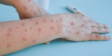 Ministerio de Salud Pùblica notifica dos nuevos casos de viruela símica en el país